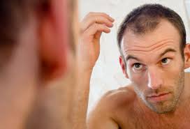 Hair loss in Males