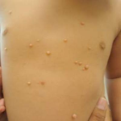 Molluscum and Homeopathy